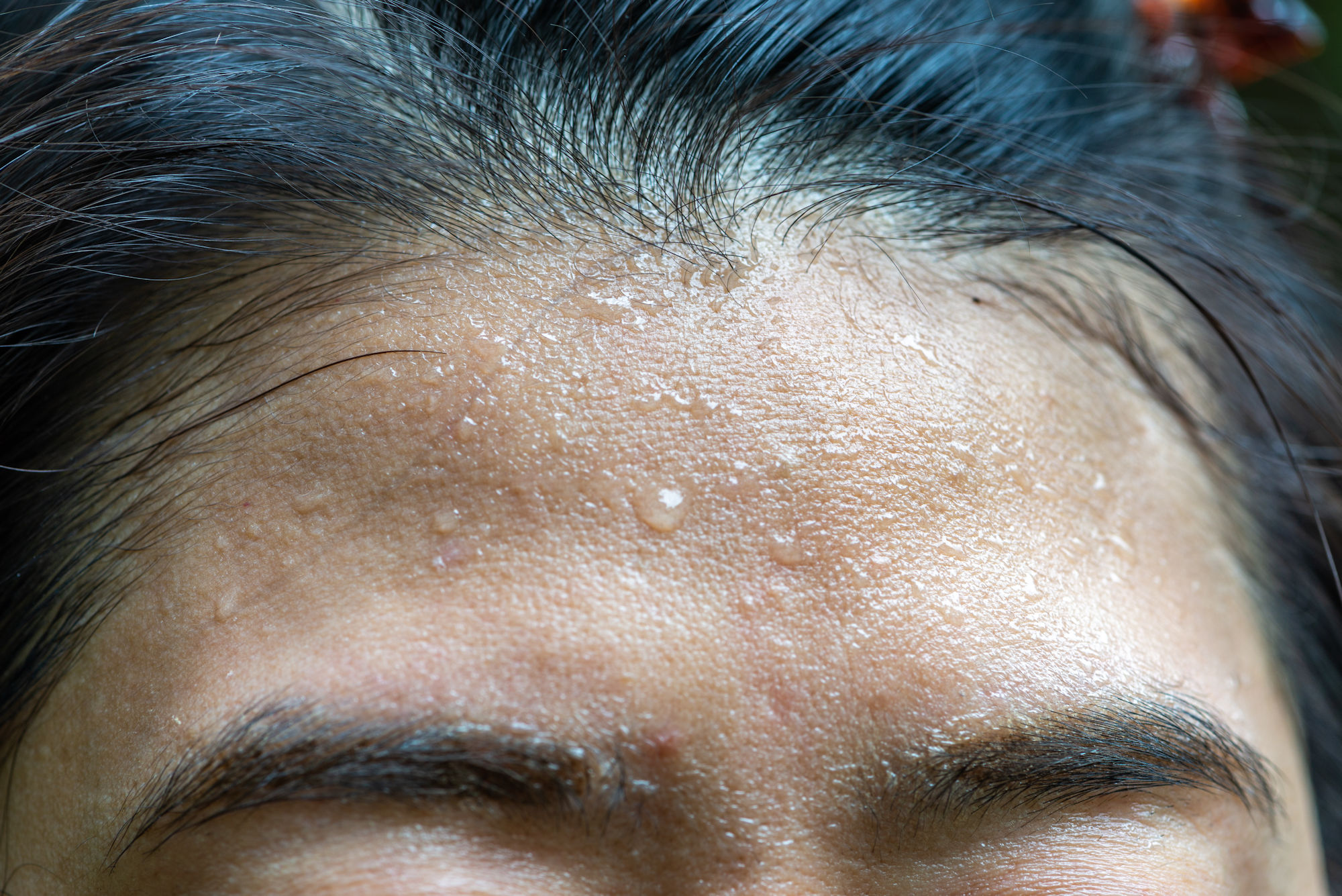 Hyperhidrosis facialis - übermäßiges Schwitzen im Gesichtsbereich